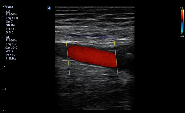 Vascular slide image02