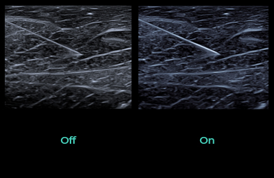  Needle Vision™ Plus