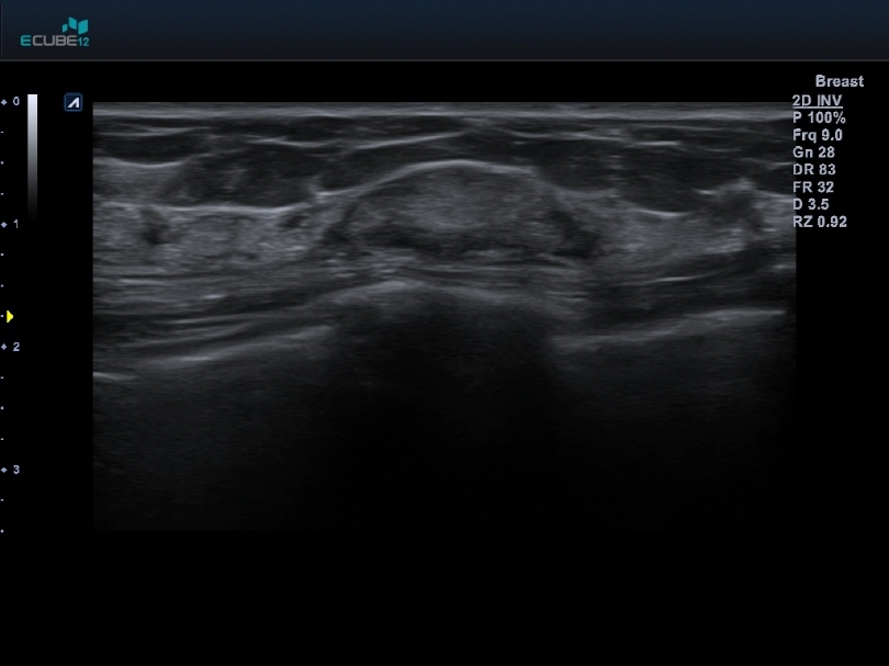 Breast nodule with L3-12HWD