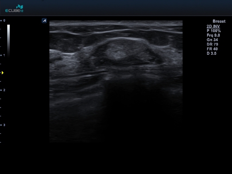 Breast nodule