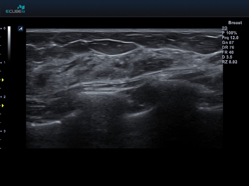 Breast with L3-12HWD