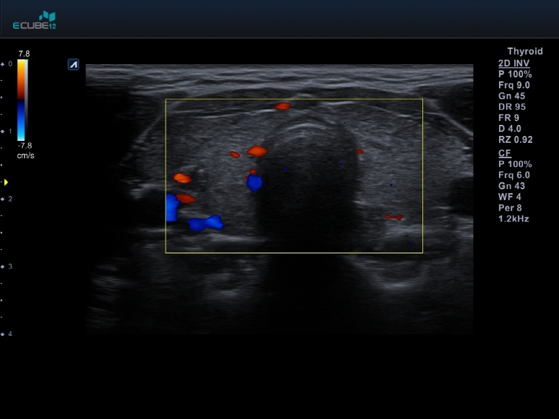 Thyroid with Color