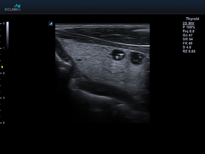 Thyroid01
