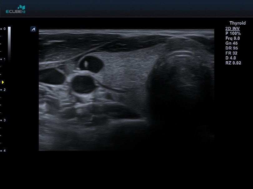 Thyroid02