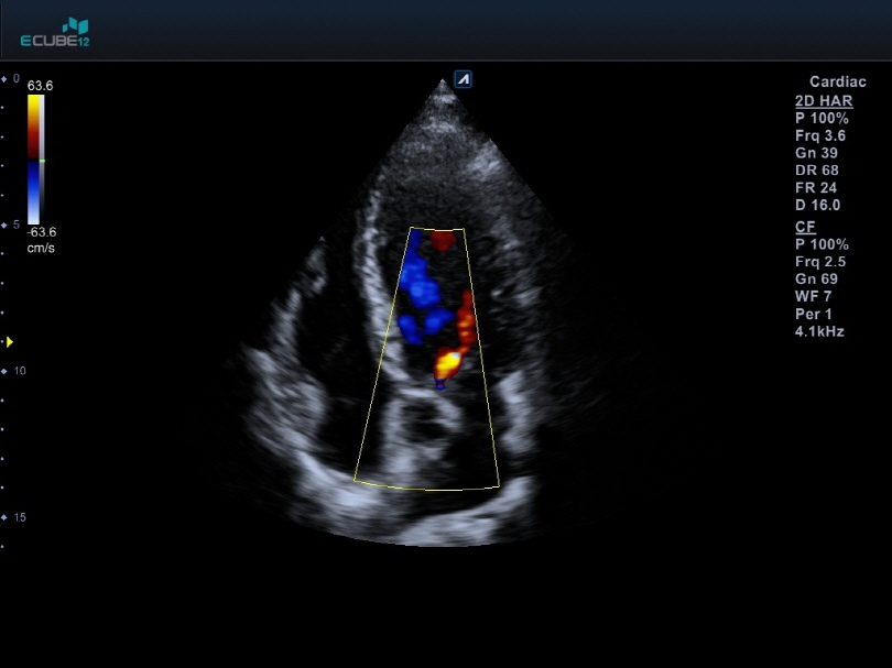 Heart 4ch view with Color