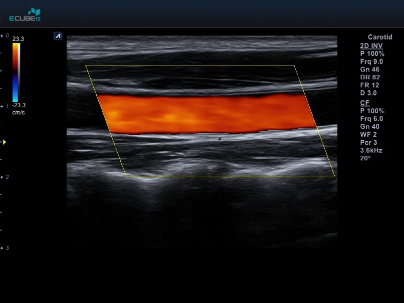 Carotid artery in Color