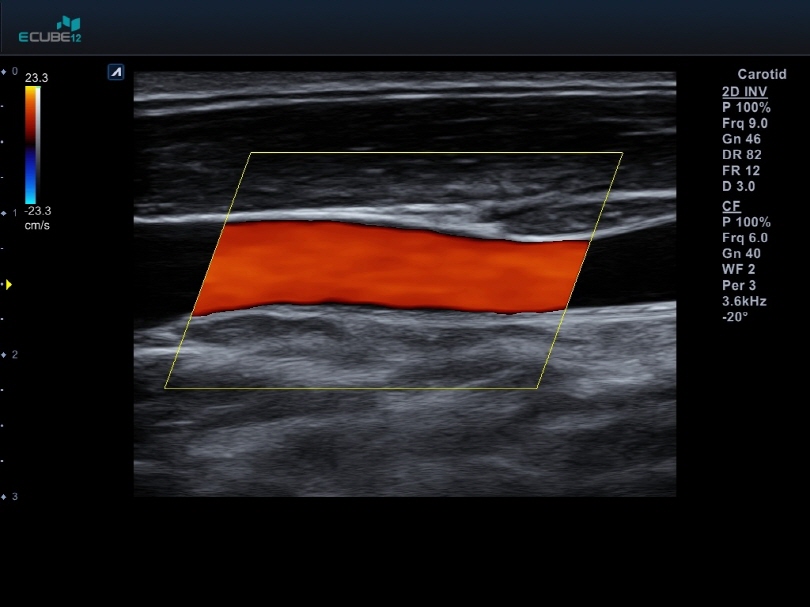 Jugular vein with Color