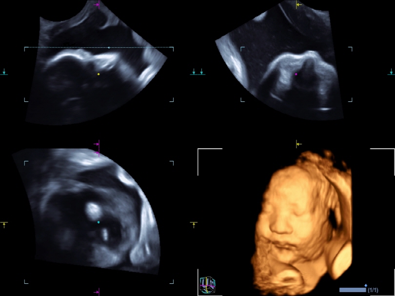 Fetal face in MPR