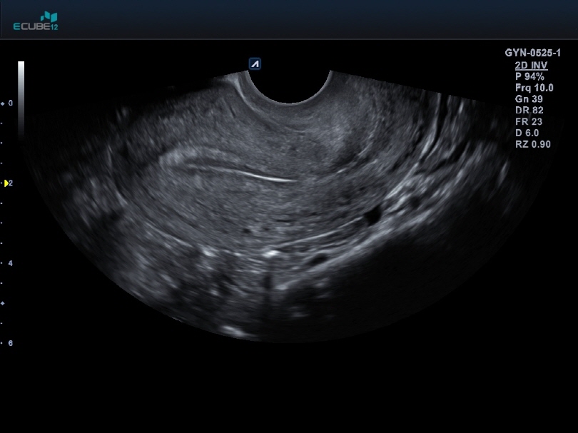Uterus longitudinal view