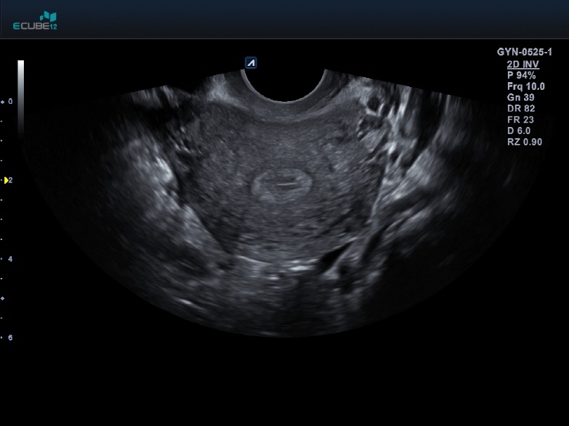 Uterus transverse view