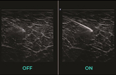 Needle Vision™ Plus