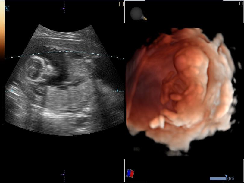 1st trimester fetus in Live HQ™