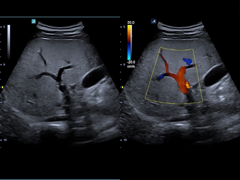 Liver in Dual Live Mode