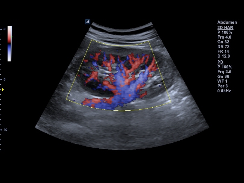 Renal vessels in Directional Power Doppler Imaging(DPDI)