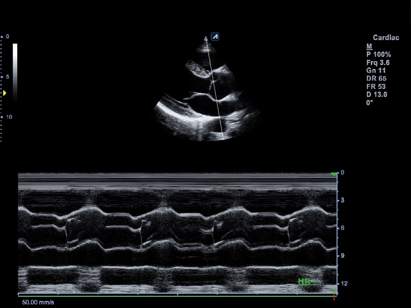 Aortic valve in M Mode