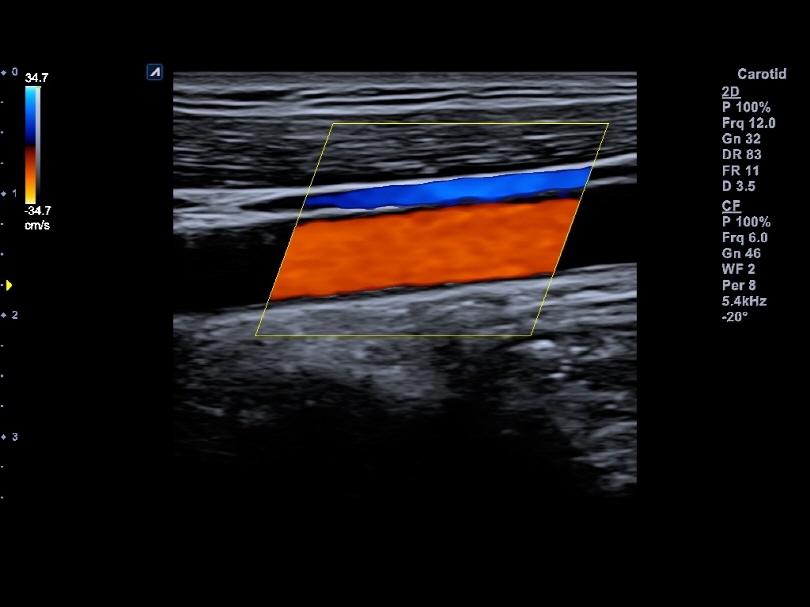 Carotid artery and jugular vein in Color Flow Mode
