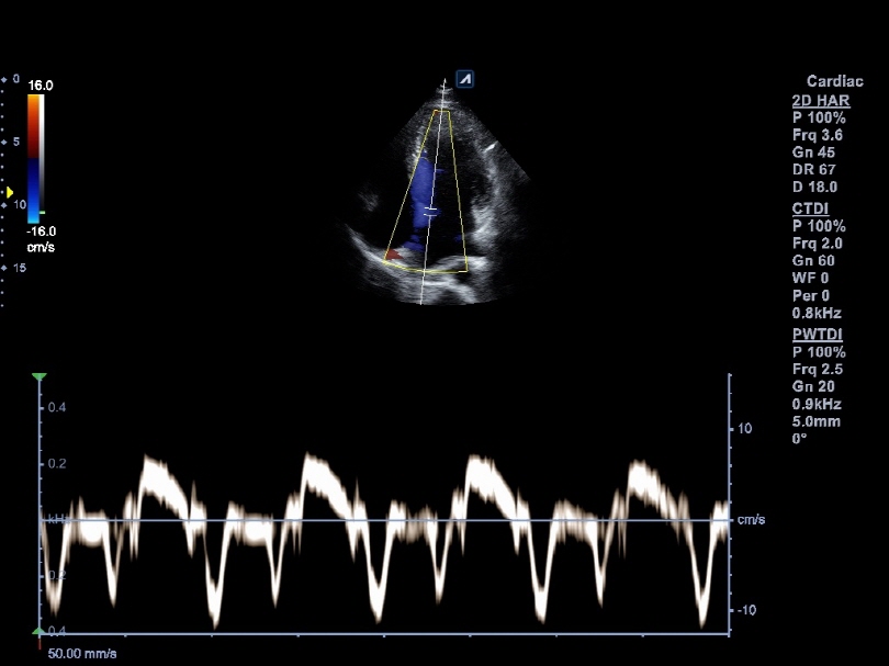 Interventricular septum in Tissue Doppler Imaging