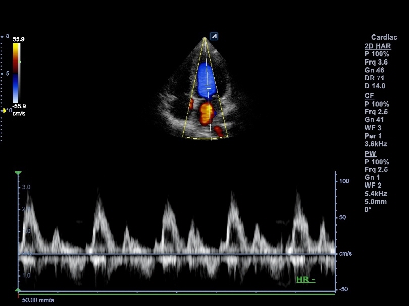 Mitral valve flow in PW