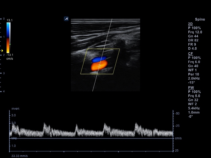 Vertebral artery in PW