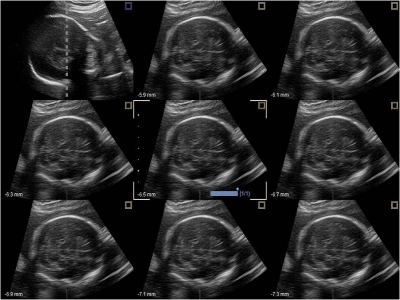 Fetal brain in MSV(Multi-Slice View)