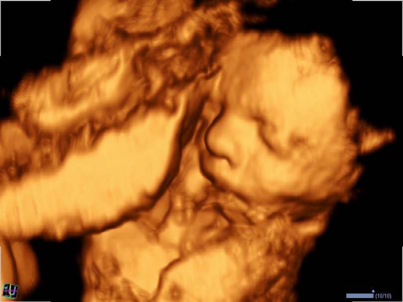 Fetal face in 3D