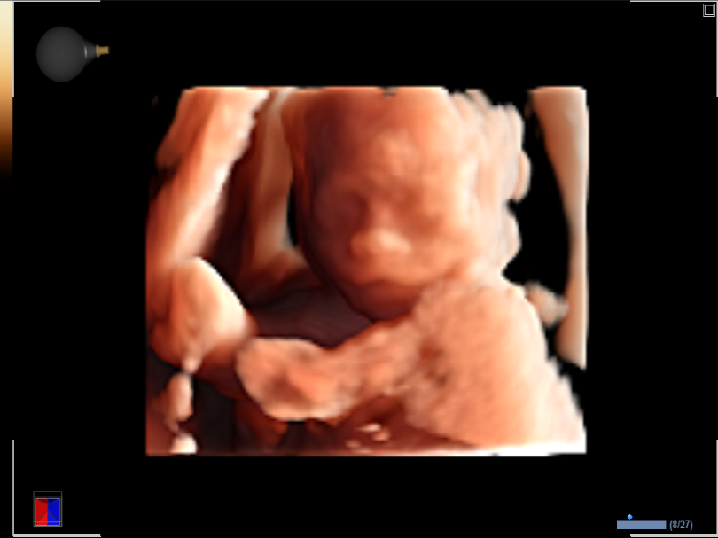 Fetal face in Live HQ™