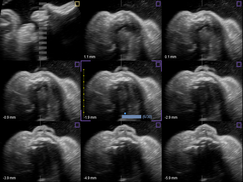 Fetal palate in MSV(Multi-Slice View)