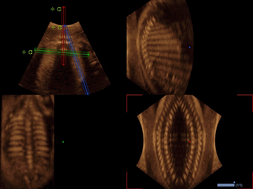 Fetal spine with AnySlice™