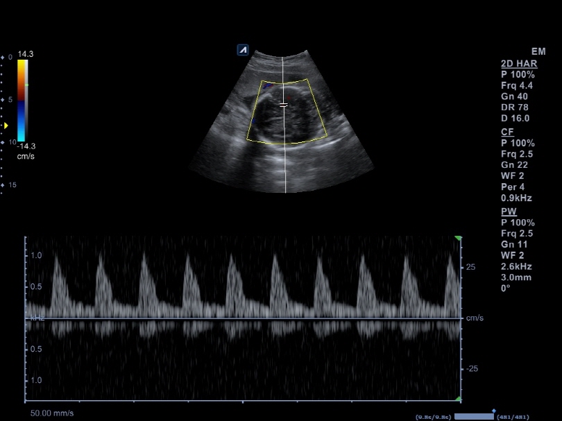 Middle Cerebral Artery in PW