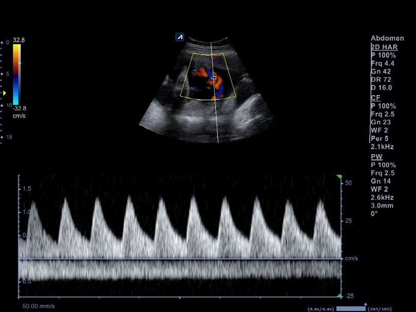 Umbilical aretery in PW
