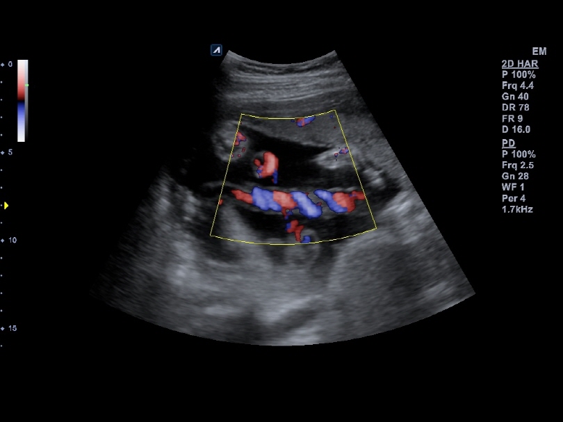 Umbilical vessels in Directional Power Doppler Imaging(DPDI)