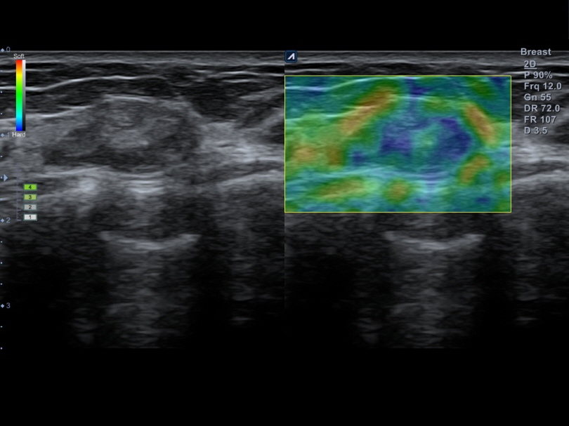 Breast nodule in Elastography