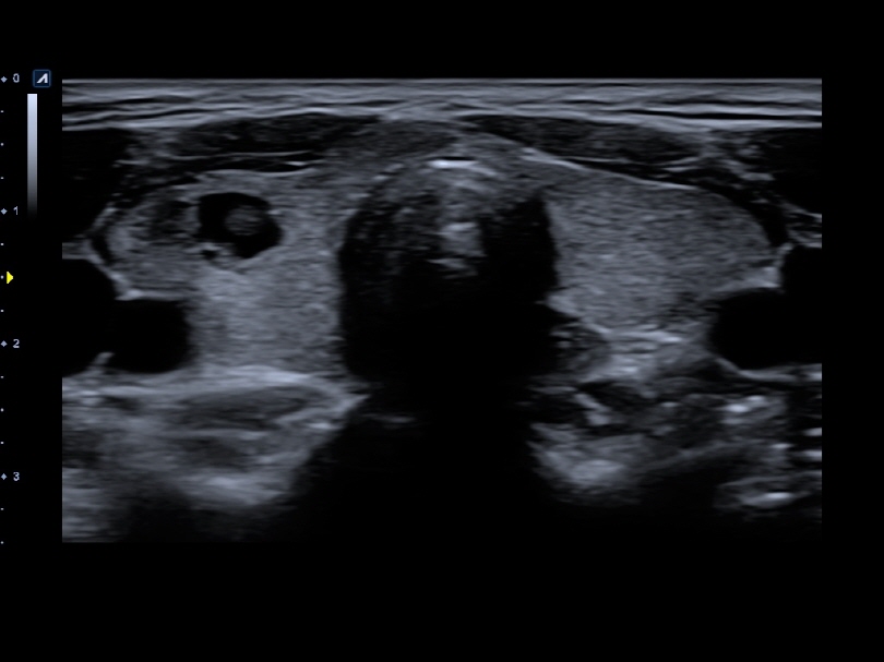 Thyroid nodule in 2D Mode