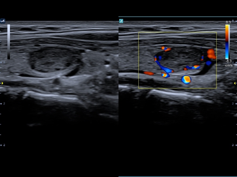 Thyroid nodule in Dual Live Mode