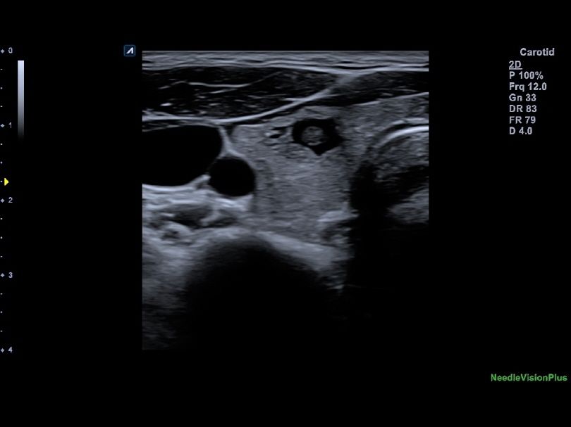 Thyroid nodule with Needle Vision Plus
