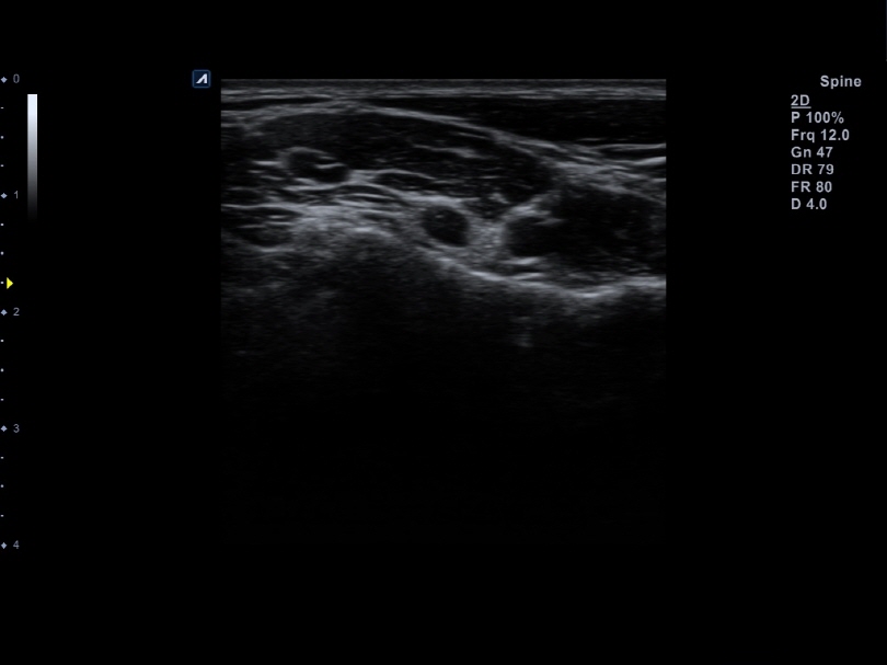 Cervical spine in 2D Mode