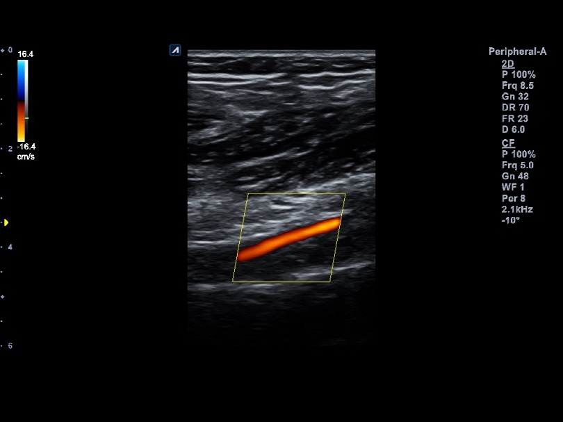 Peripheral artery in Color Flow Mode