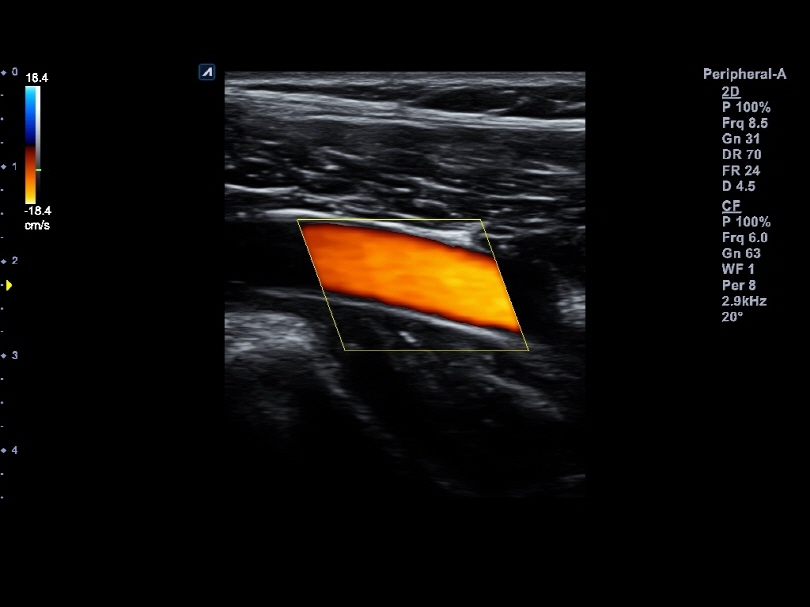 Peripheral artery of lower extremity in Color Flow Mode