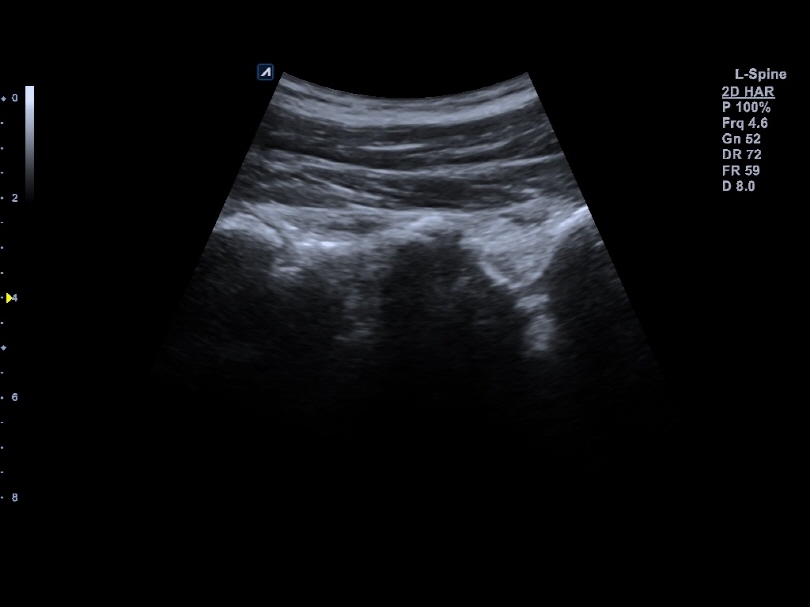 Spine with Convex transducer