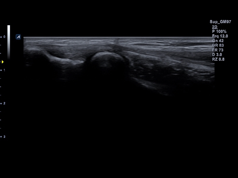 Superficial area of elbow in 2D Mode