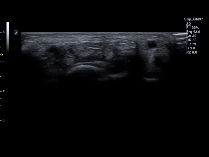 Superficial area of wrist in 2D Mode