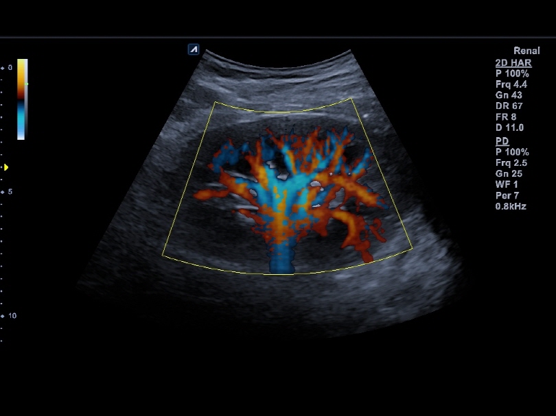 Kidney in Directional Power Doppler Imaing(DPDI)1