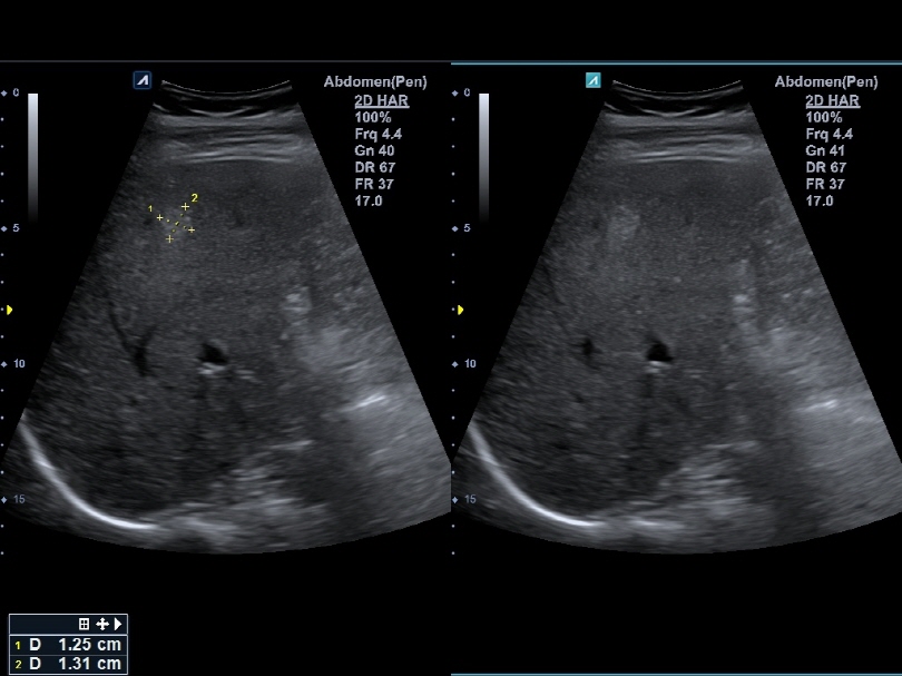 Liver in Live Dual Mode1