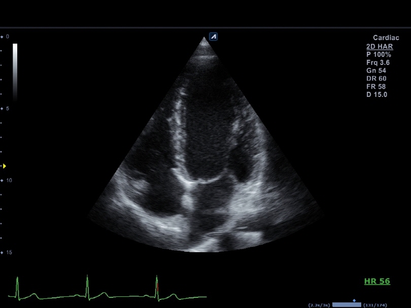 Chamber View in 2D Mode1
