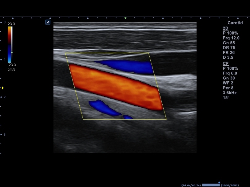 Carotid Artery and Jugular Vein in Color Flow Mode1