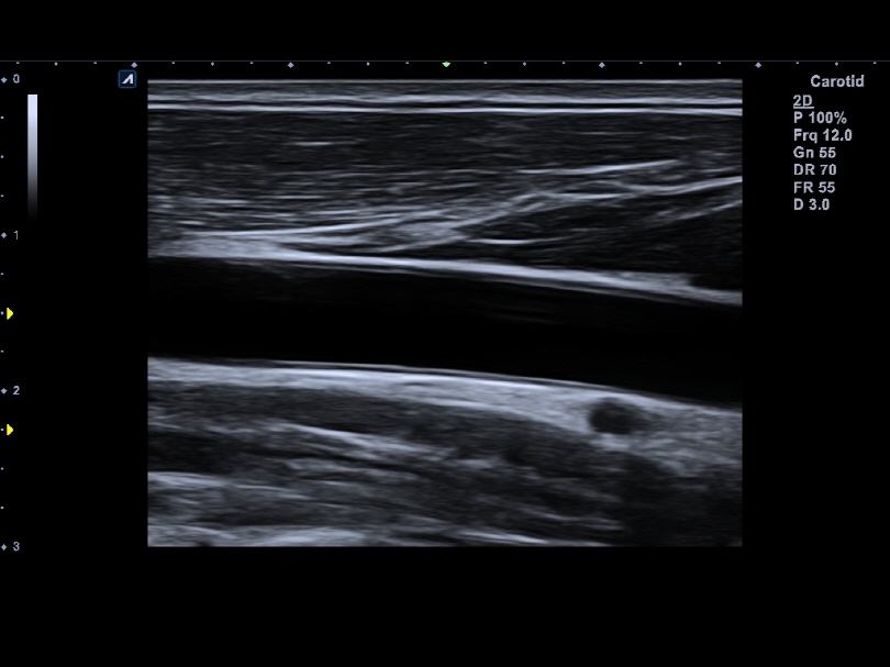 Carotid Artery in 2D Mode1