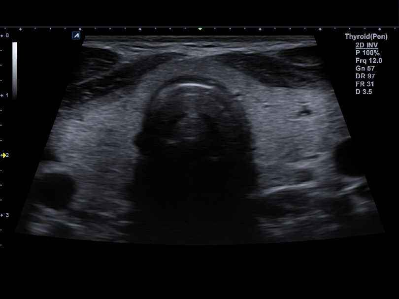 Thyroid in 2D Mode1