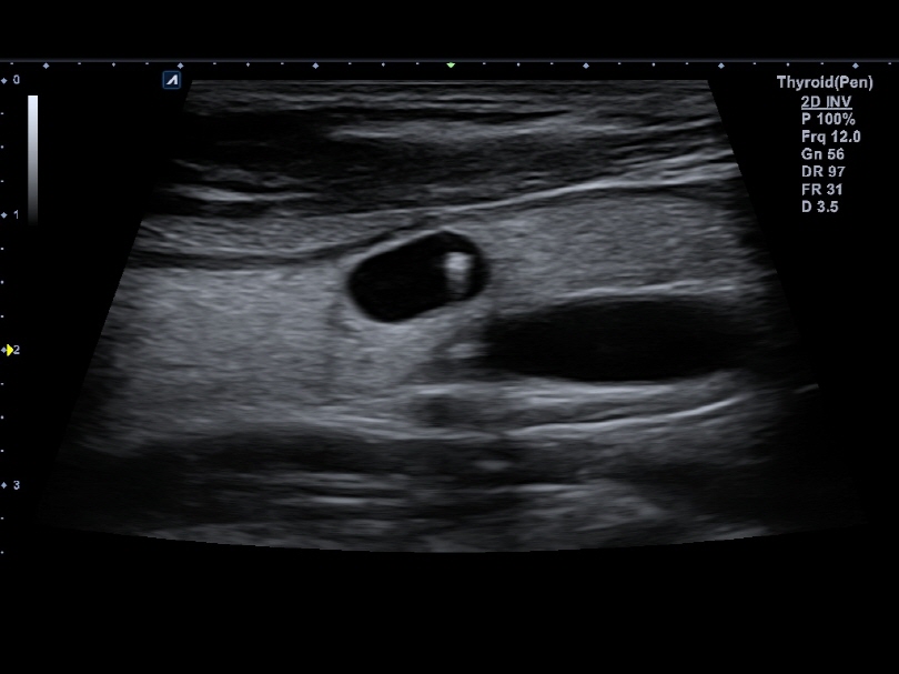 Thyroid Nodule in 2D Mode1