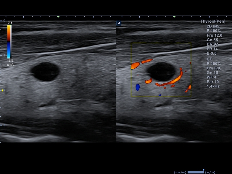 Thyroid Nodule in Dual Mode1