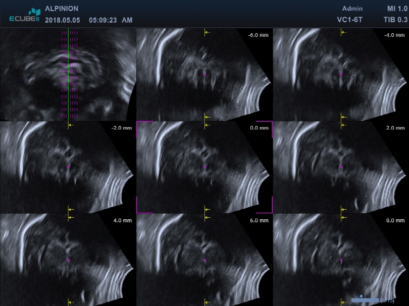 Fetal Brain in Multi Slice View of Volume Master™1